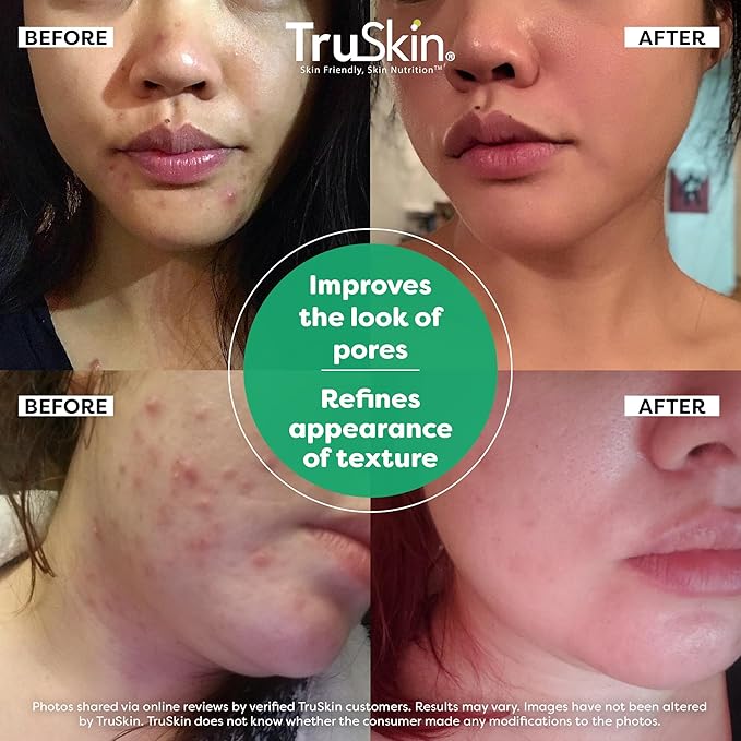 TruSkin Tea Tree Oil Acne Treatment for Face – Acne Serum – Improve the Appearance of Pores, Skin Tone for Smooth, Glowing Skin with Salicylic Acid, Vitamin C, Niacinamide & Retinol, 2 OZ